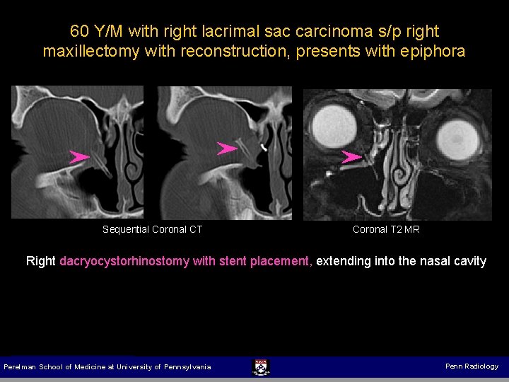 60 Y/M with right lacrimal sac carcinoma s/p right maxillectomy with reconstruction, presents with