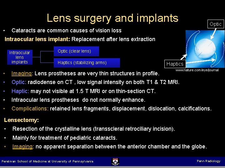 Lens surgery and implants Optic • Cataracts are common causes of vision loss Intraocular
