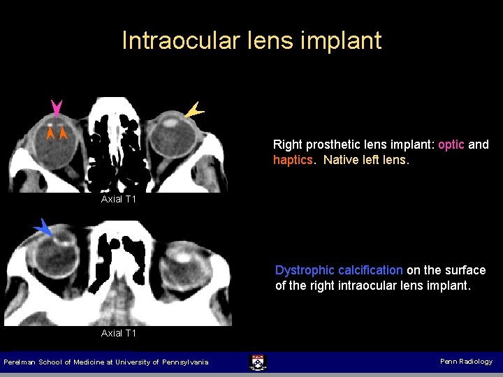 Intraocular lens implant Right prosthetic lens implant: optic and haptics. Native left lens. Axial