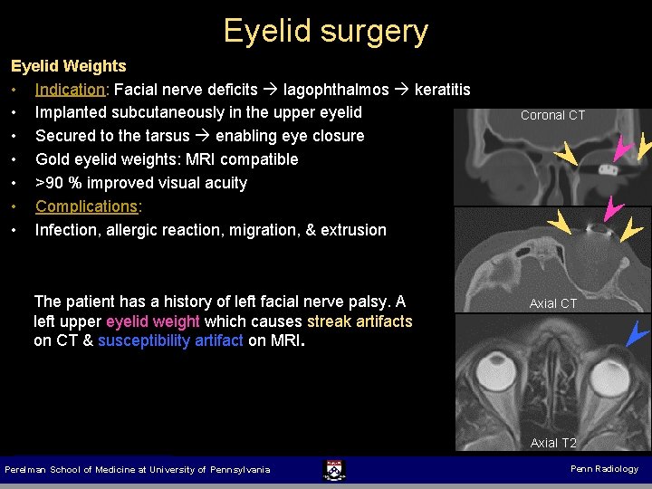 Eyelid surgery Eyelid Weights • Indication: Facial nerve deficits lagophthalmos keratitis • Implanted subcutaneously