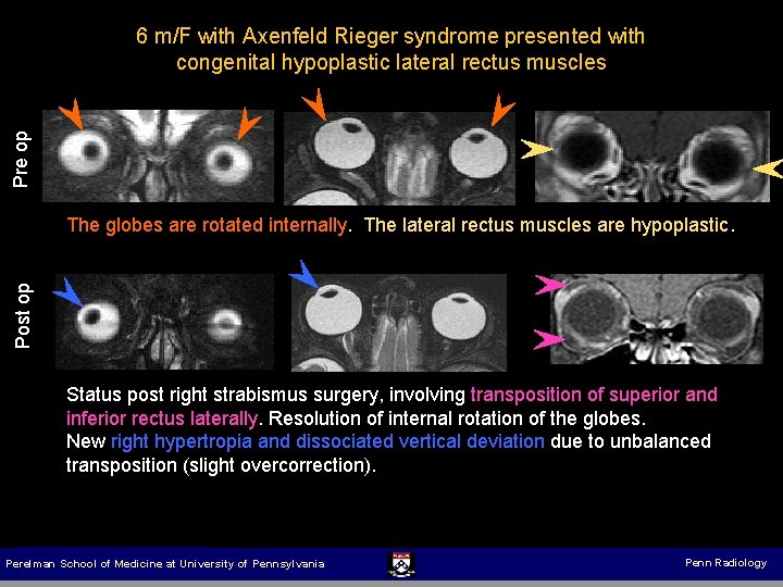 Pre op 6 m/F with Axenfeld Rieger syndrome presented with congenital hypoplastic lateral rectus