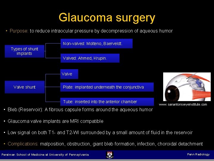 Glaucoma surgery • Purpose: to reduce intraocular pressure by decompression of aqueous humor Non-valved: