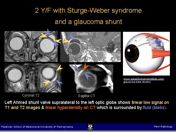 2 Y/F with Sturge-Weber syndrome and a glaucoma shunt Sagittal T 1 www. sanantonioeyeinstitute.