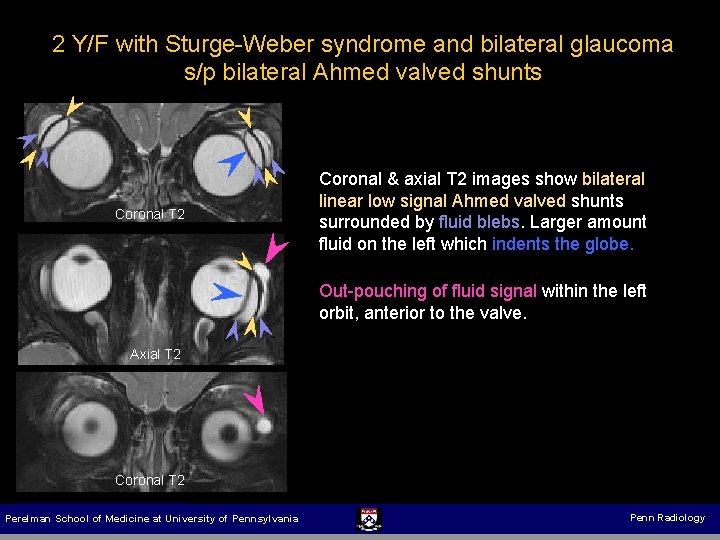 2 Y/F with Sturge-Weber syndrome and bilateral glaucoma s/p bilateral Ahmed valved shunts Coronal