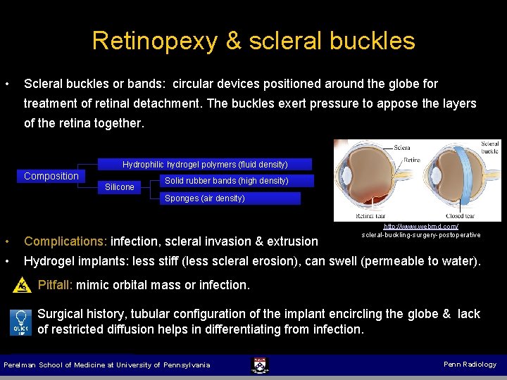 Retinopexy & scleral buckles • Scleral buckles or bands: circular devices positioned around the