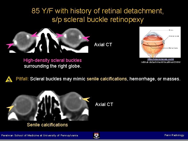 85 Y/F with history of retinal detachment, s/p scleral buckle retinopexy Axial CT http: