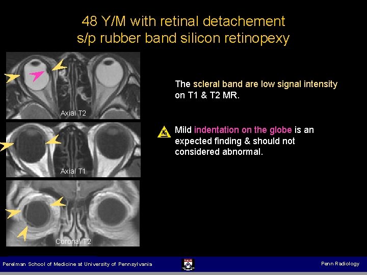 48 Y/M with retinal detachement s/p rubber band silicon retinopexy The scleral band are