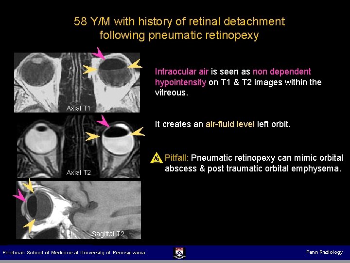58 Y/M with history of retinal detachment following pneumatic retinopexy Intraocular air is seen