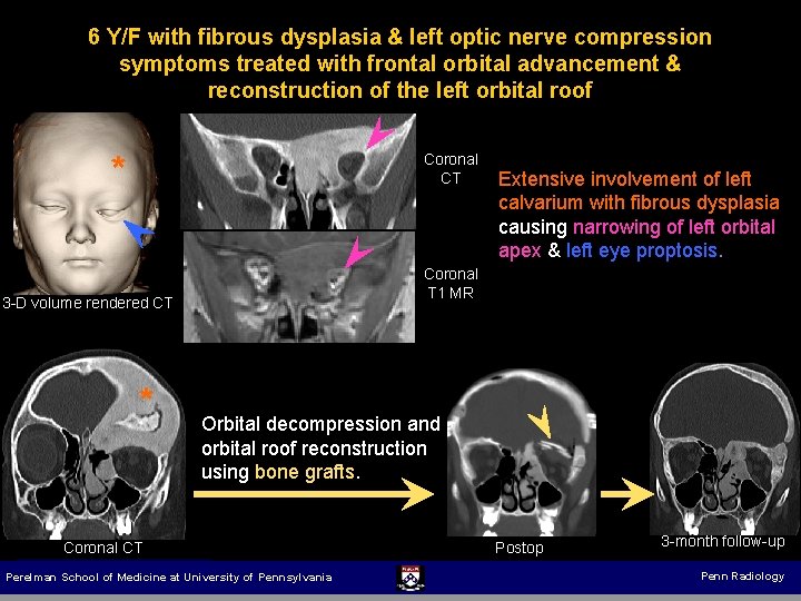 6 Y/F with fibrous dysplasia & left optic nerve compression symptoms treated with frontal