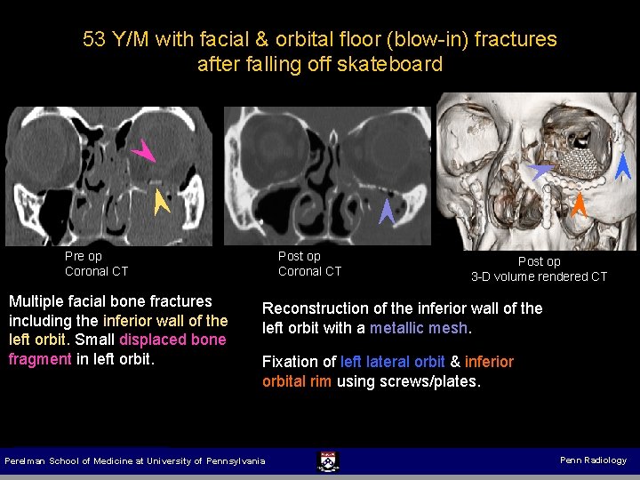 53 Y/M with facial & orbital floor (blow-in) fractures after falling off skateboard Pre