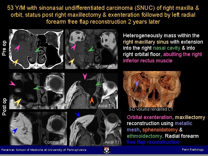 53 Y/M with sinonasal undifferentiated carcinoma (SNUC) of right maxilla & orbit, status post