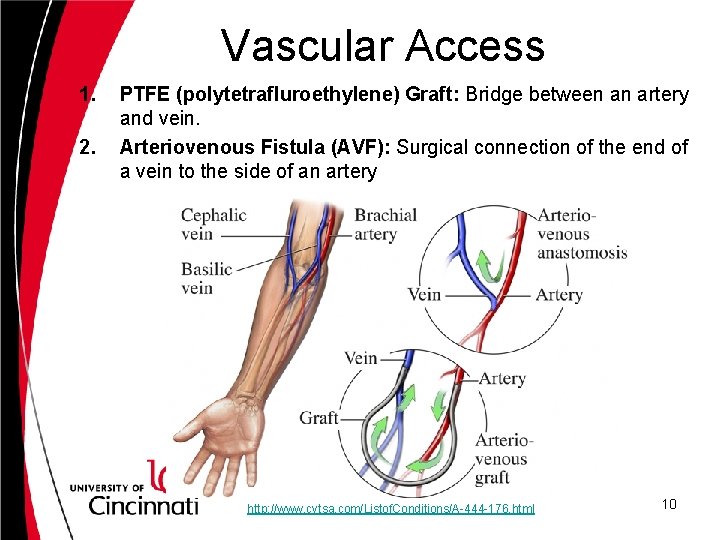 Vascular Access 1. 2. PTFE (polytetrafluroethylene) Graft: Bridge between an artery and vein. Arteriovenous
