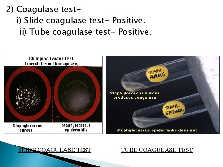 2) Coagulase testi) Slide coagulase test- Positive. ii) Tube coagulase test- Positive. SLIDE COAGULASE