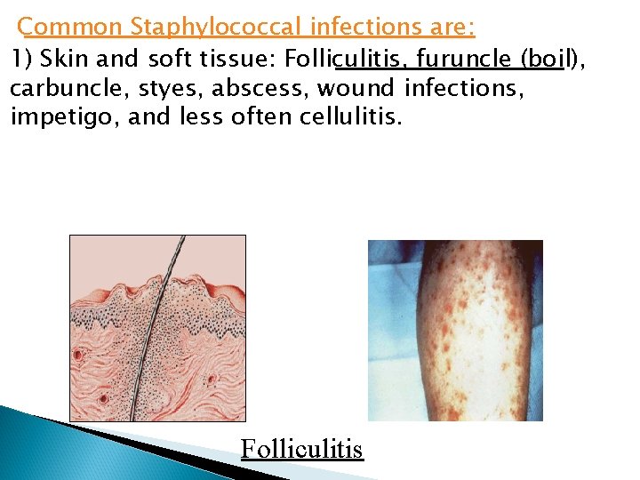 Common Staphylococcal infections are: 1) Skin and soft tissue: Folliculitis, furuncle (boil), carbuncle, styes,