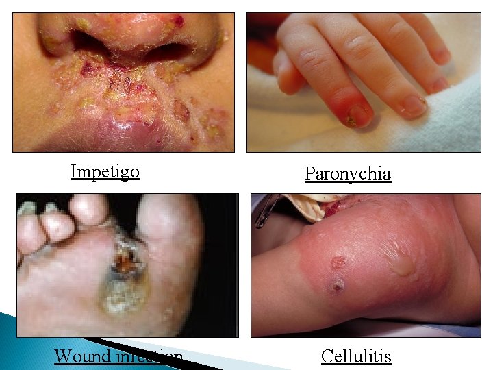 Impetigo Wound infection Paronychia Cellulitis 