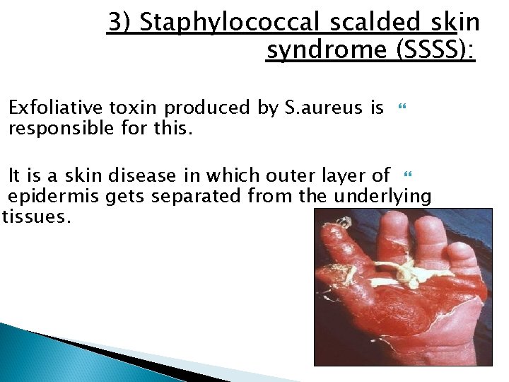 3) Staphylococcal scalded skin syndrome (SSSS): Exfoliative toxin produced by S. aureus is responsible