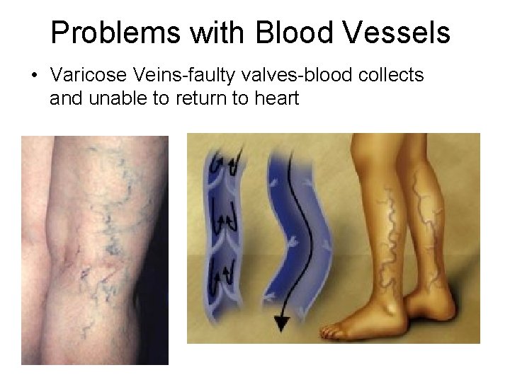 Problems with Blood Vessels • Varicose Veins-faulty valves-blood collects and unable to return to
