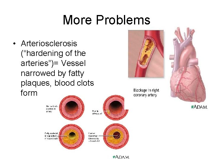 More Problems • Arteriosclerosis (“hardening of the arteries”)= Vessel narrowed by fatty plaques, blood