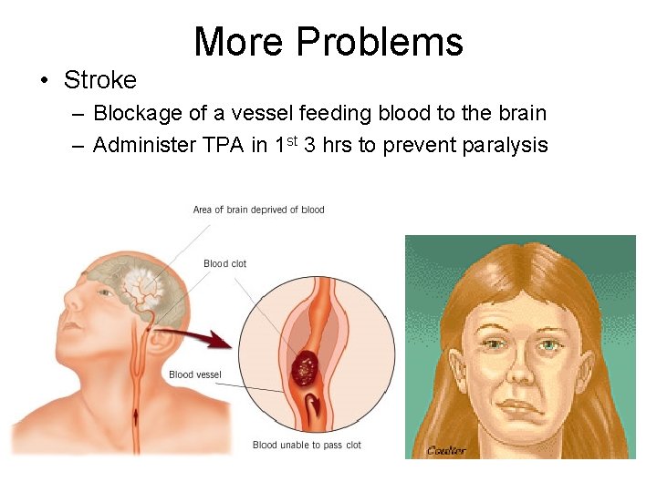 More Problems • Stroke – Blockage of a vessel feeding blood to the brain