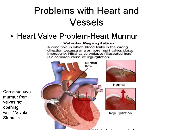 Problems with Heart and Vessels • Heart Valve Problem-Heart Murmur Can also have murmur