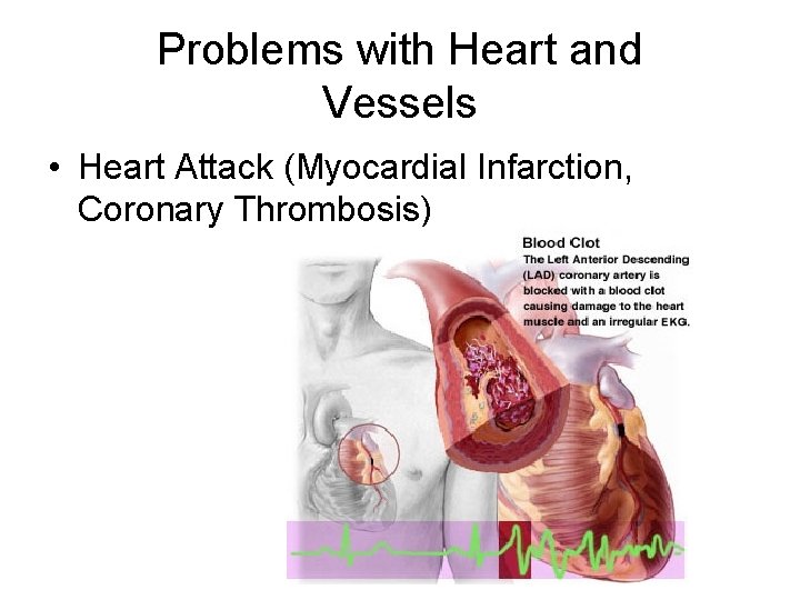 Problems with Heart and Vessels • Heart Attack (Myocardial Infarction, Coronary Thrombosis) 