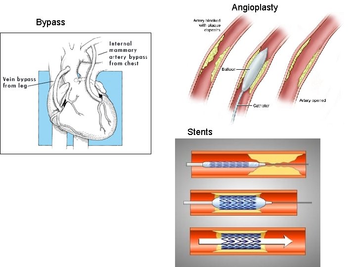 Angioplasty Bypass Stents 