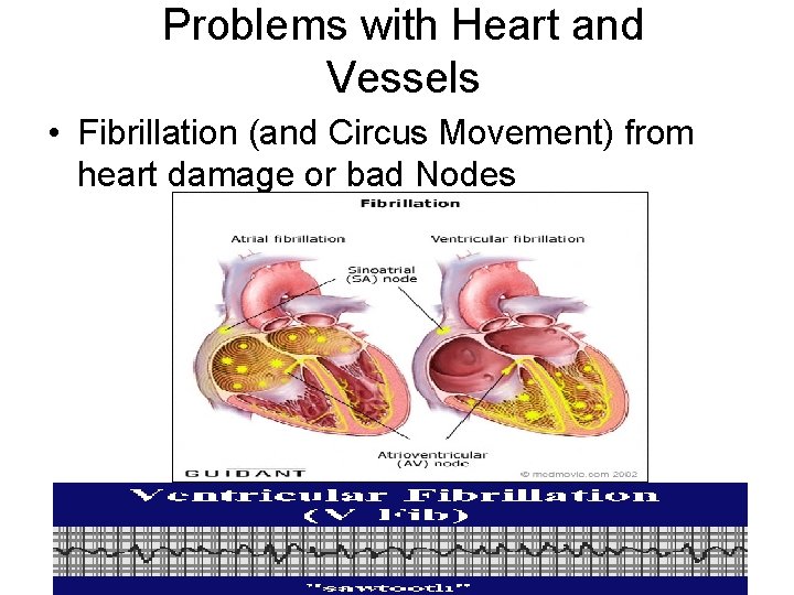 Problems with Heart and Vessels • Fibrillation (and Circus Movement) from heart damage or