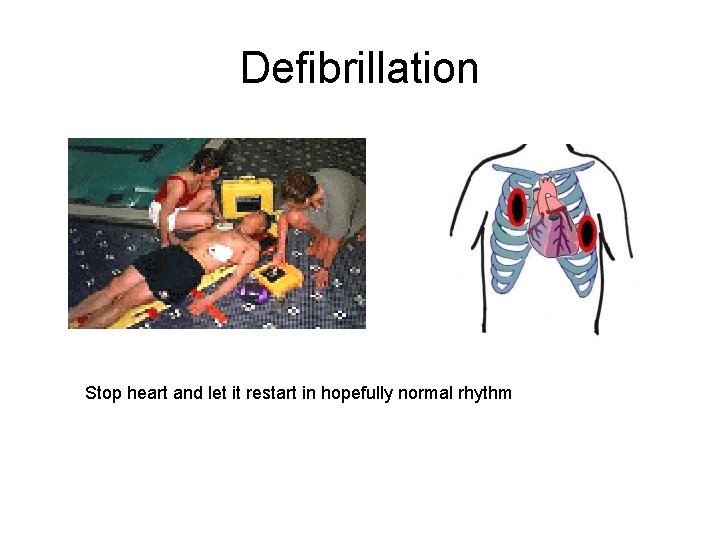 Defibrillation Stop heart and let it restart in hopefully normal rhythm 