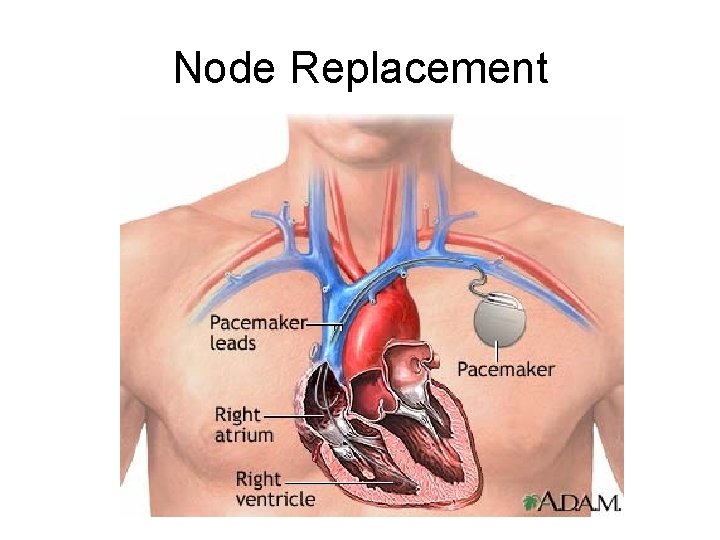 Node Replacement 