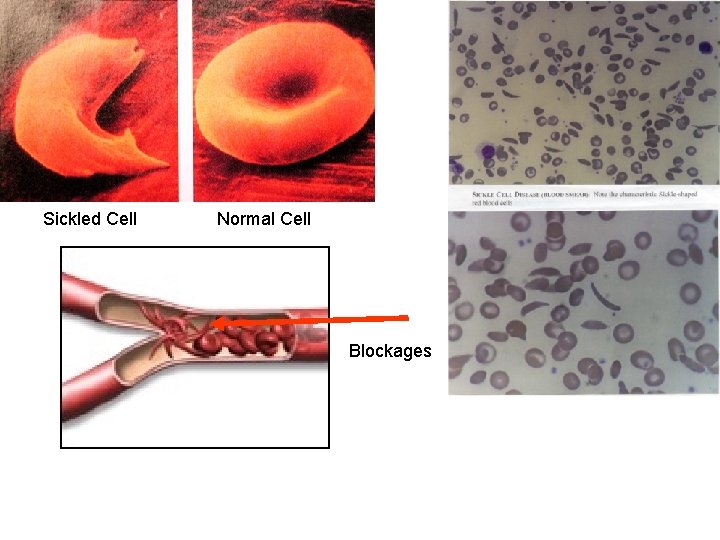 Sickled Cell Normal Cell Blockages 