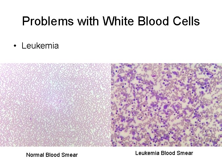 Problems with White Blood Cells • Leukemia Normal Blood Smear Leukemia Blood Smear 