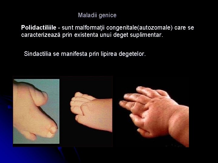 Maladii genice Polidactiliile - sunt malformaţii congenitale(autozomale) care se caracterizează prin existenta unui deget