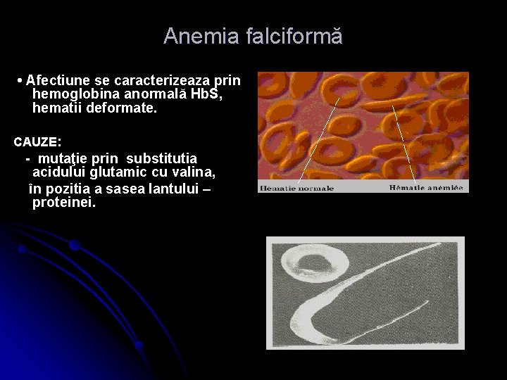 Anemia falciformă • Afectiune se caracterizeaza prin hemoglobina anormală Hb. S, hematii deformate. CAUZE:
