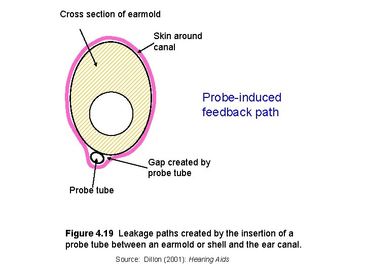 Cross section of earmold Skin around canal Probe-induced feedback path Gap created by probe