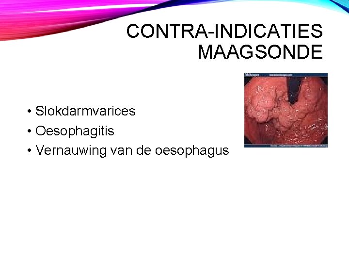 CONTRA-INDICATIES MAAGSONDE • Slokdarmvarices • Oesophagitis • Vernauwing van de oesophagus 