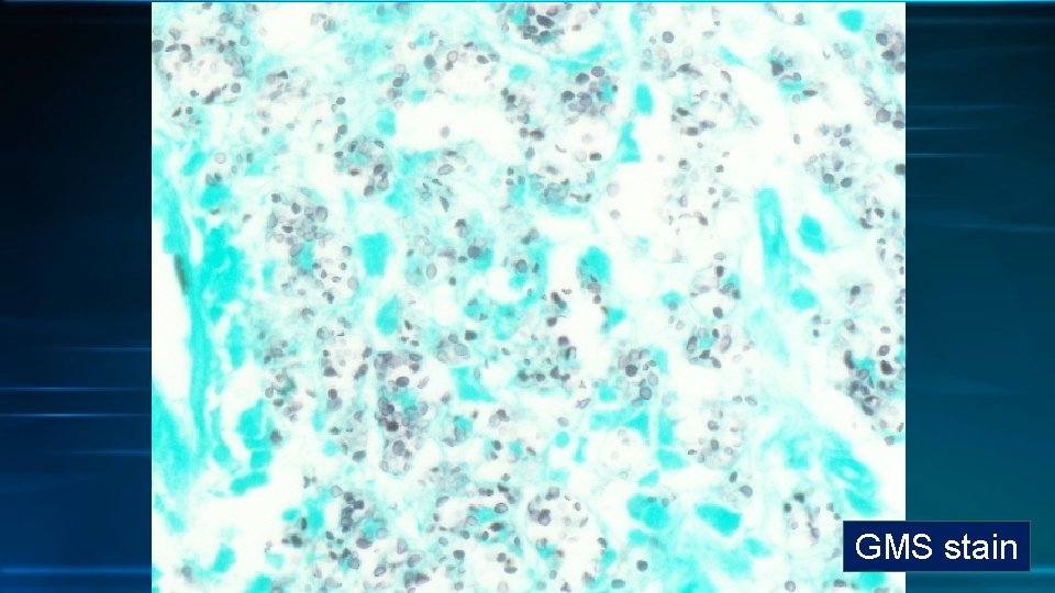GMS stain 