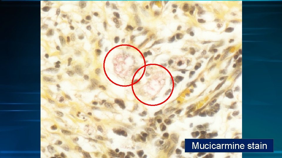 Mucicarmine stain 