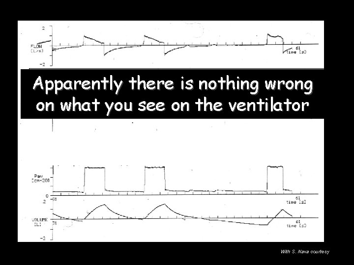 Apparently there is nothing wrong on what you see on the ventilator With S. Apparently there is nothing wrong on what you see on the ventilator With S.