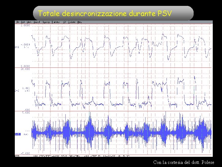 Totale desincronizzazione durante PSV Con la cortesia del dott. Polese Totale desincronizzazione durante PSV Con la cortesia del dott. Polese