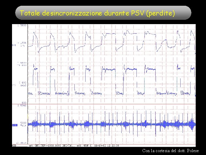 Totale desincronizzazione durante PSV (perdite) Con la cortesia del dott. Polese Totale desincronizzazione durante PSV (perdite) Con la cortesia del dott. Polese