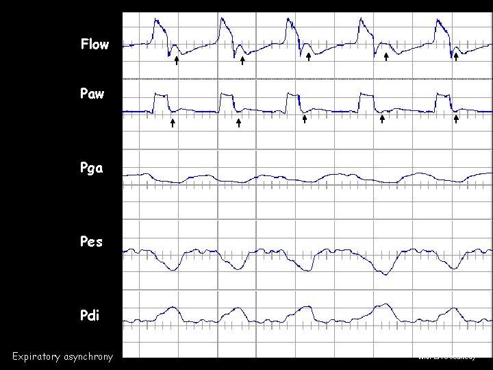 Flow Paw Pga Pes Pdi Expiratory asynchrony With ERS courtesy Flow Paw Pga Pes Pdi Expiratory asynchrony With ERS courtesy