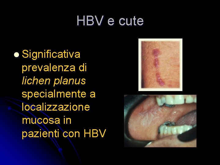 HBV e cute l Significativa prevalenza di lichen planus specialmente a localizzazione mucosa in
