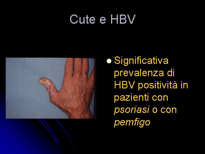 Cute e HBV l Significativa prevalenza di HBV positività in pazienti con psoriasi o