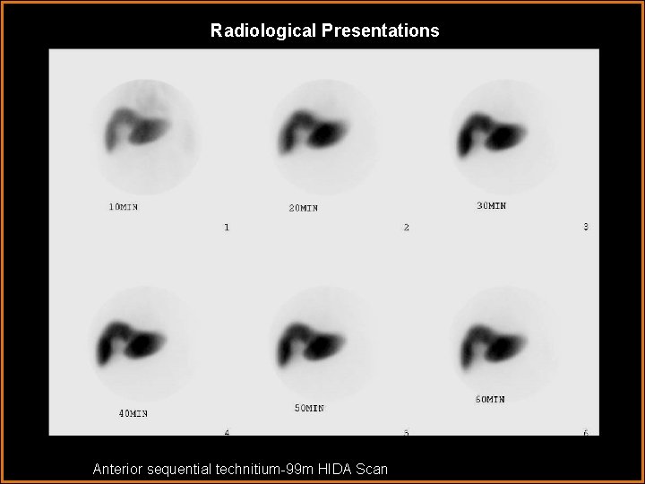 Radiological Presentations Anterior sequential technitium-99 m HIDA Scan 