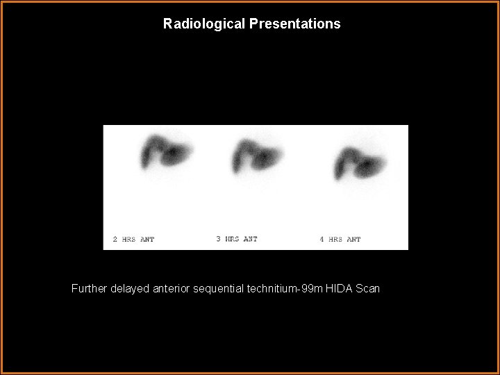 Radiological Presentations Further delayed anterior sequential technitium-99 m HIDA Scan 