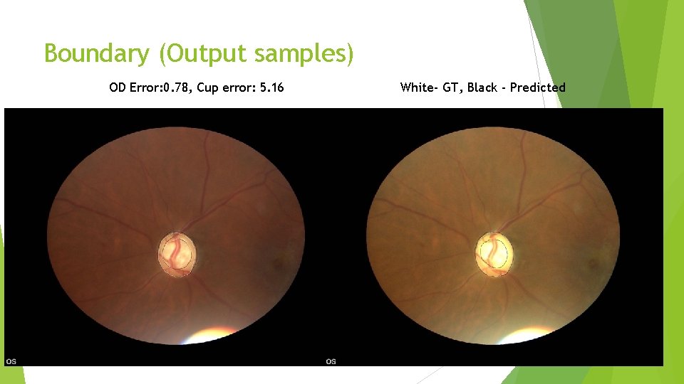 Boundary (Output samples) OD Error: 0. 78, Cup error: 5. 16 White- GT, Black Boundary (Output samples) OD Error: 0. 78, Cup error: 5. 16 White- GT, Black