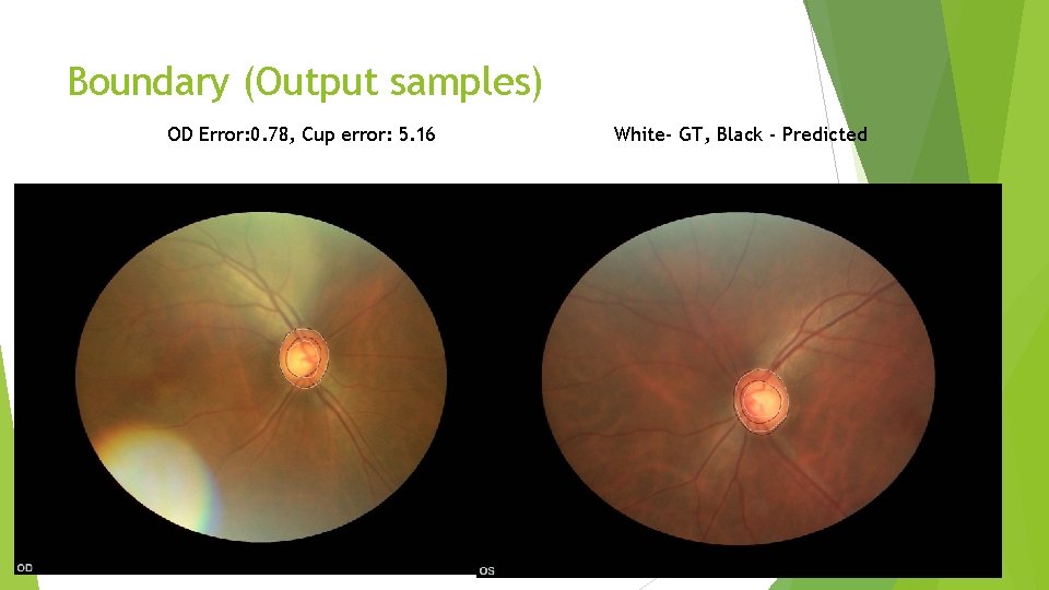 Boundary (Output samples) OD Error: 0. 78, Cup error: 5. 16 White- GT, Black Boundary (Output samples) OD Error: 0. 78, Cup error: 5. 16 White- GT, Black