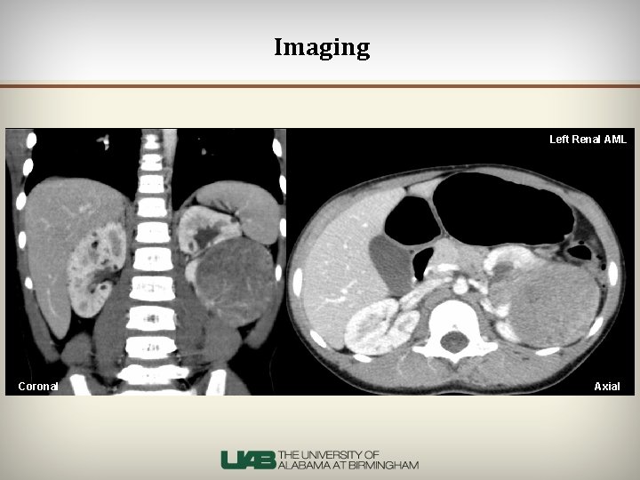 Imaging Left Renal AML Coronal Axial 