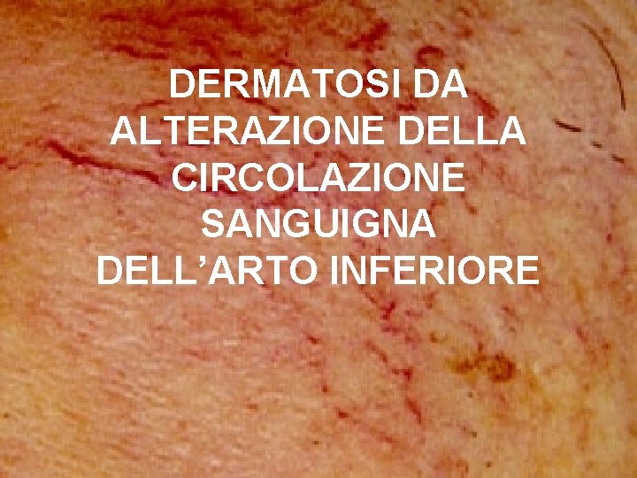 DERMATOSI DA ALTERAZIONE DELLA CIRCOLAZIONE SANGUIGNA DELL’ARTO INFERIORE 