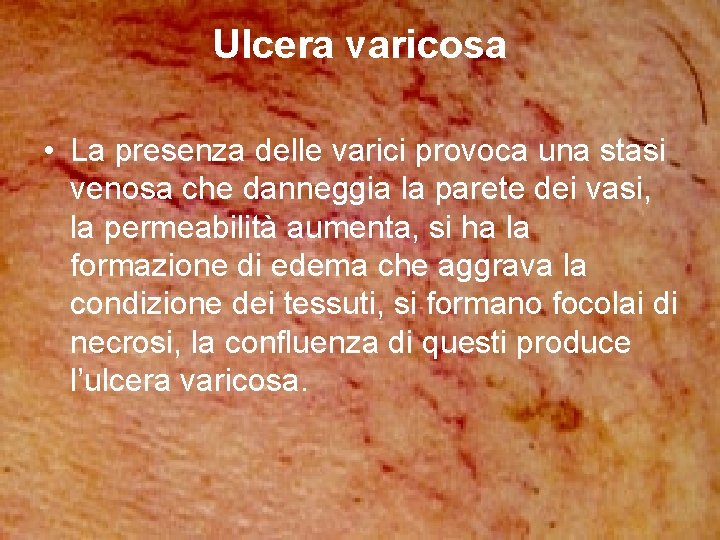 Ulcera varicosa • La presenza delle varici provoca una stasi venosa che danneggia la Ulcera varicosa • La presenza delle varici provoca una stasi venosa che danneggia la